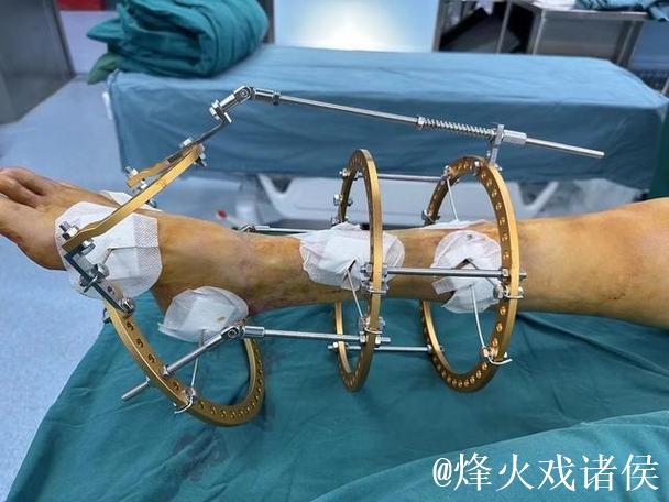 拜仁中场托利索接受脚踝手术